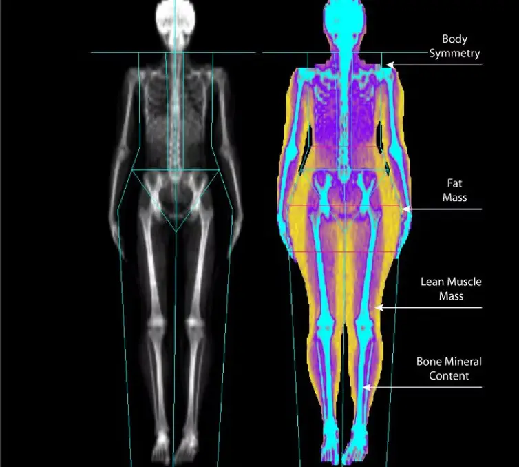 A DEXA image showing bone, fat and lean muscle across the whole body